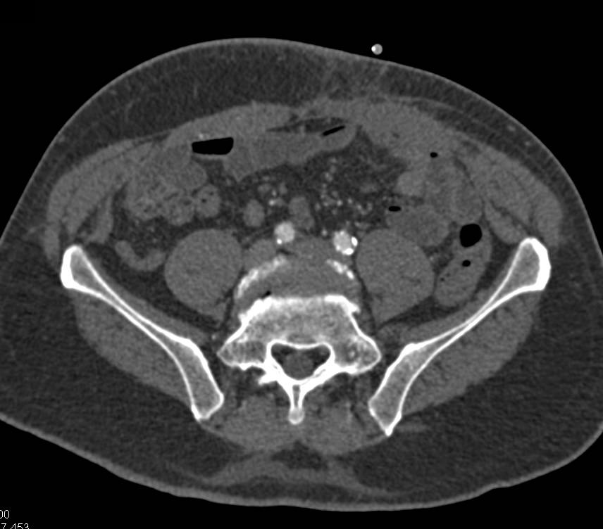 CTA Runoff with Vascular Enhancement with Bone Removal - CTisus CT Scan