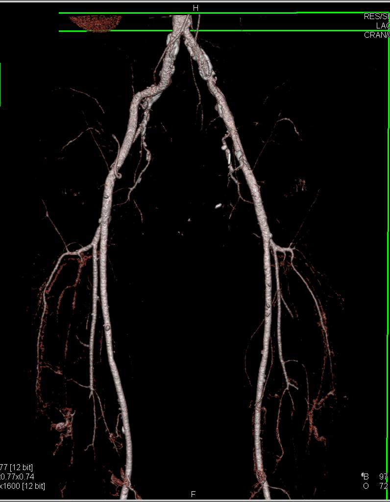 CTA Runoff with Dual Energy CT with Milld Atherosclerotic Plaque - CTisus CT Scan