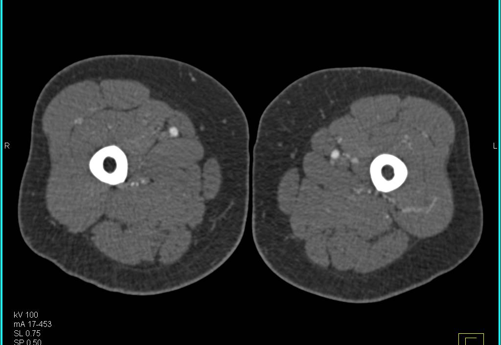 CTA Runoff with Minimal Plaque - CTisus CT Scan