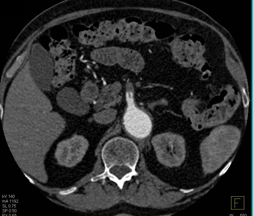 Superior Mesenteric Artery (SMA) Dissection as Spontaneous Event - CTisus CT Scan