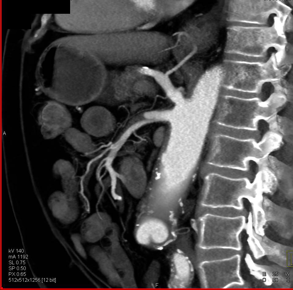 Focal Dissection in the SMA - CTisus CT Scan