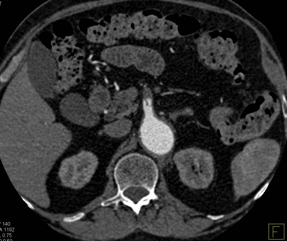 Superior Mesenteric Artery (SMA) Dissection - CTisus CT Scan