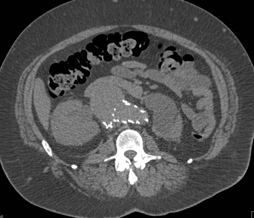 Abdominal Aortic Aneurysm with Failed Endovascular Stent - CTisus CT Scan