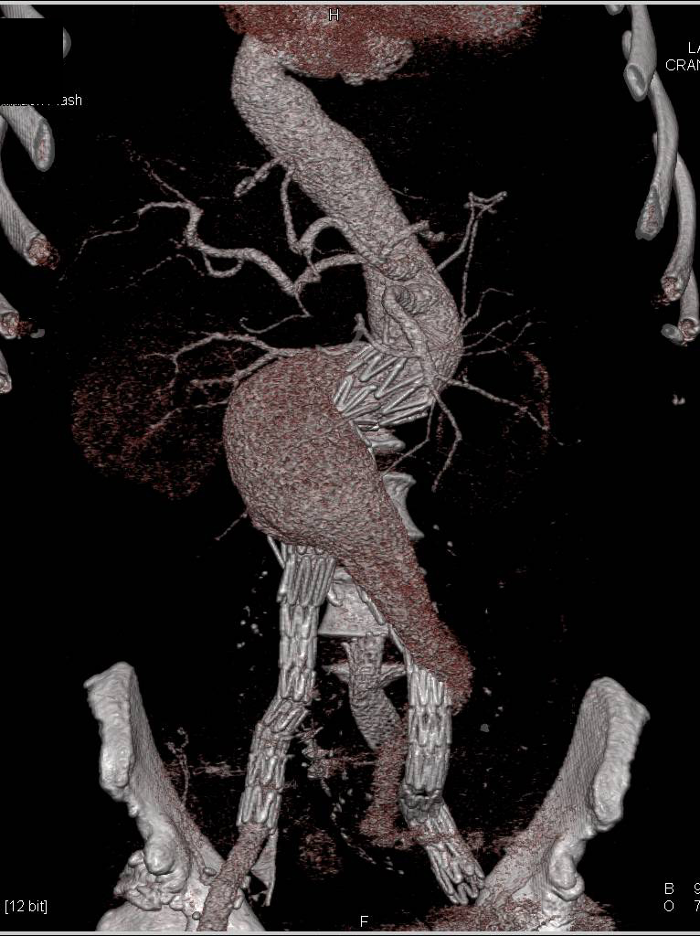 Failed Endovascular Stent with Fracturs - CTisus CT Scan