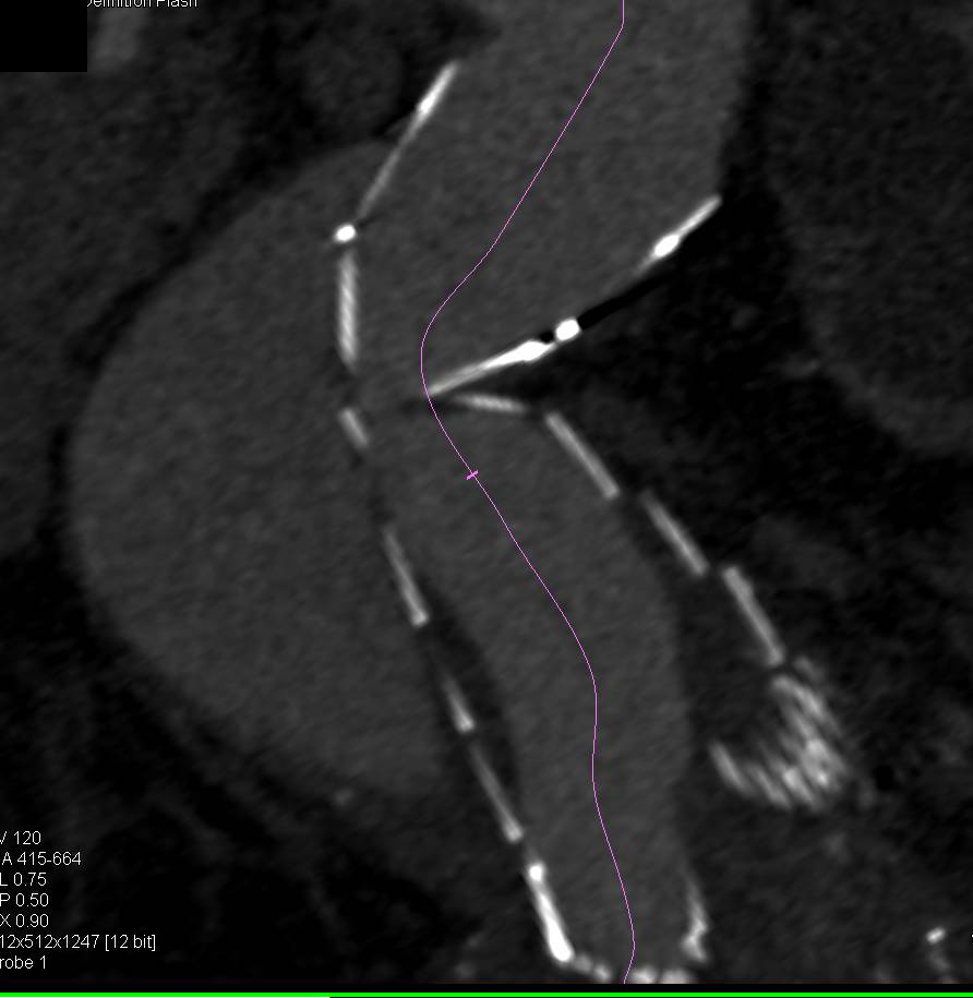 Failing Stent using MIP Imaging - CTisus CT Scan