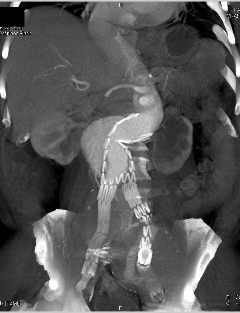 Endovascular Stent That is Failing - CTisus CT Scan