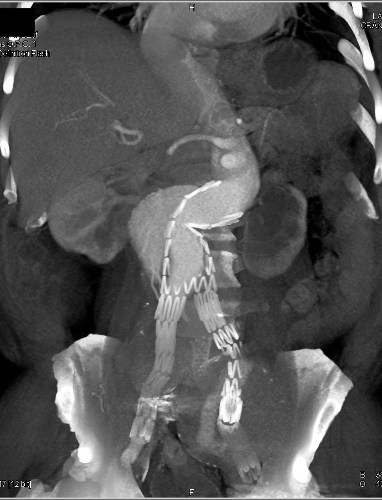 Endoleak with Failed Stent - CTisus CT Scan