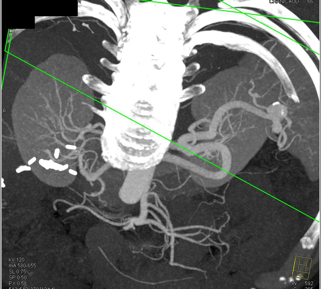 Splenic Artery Aneurysm - CTisus CT Scan