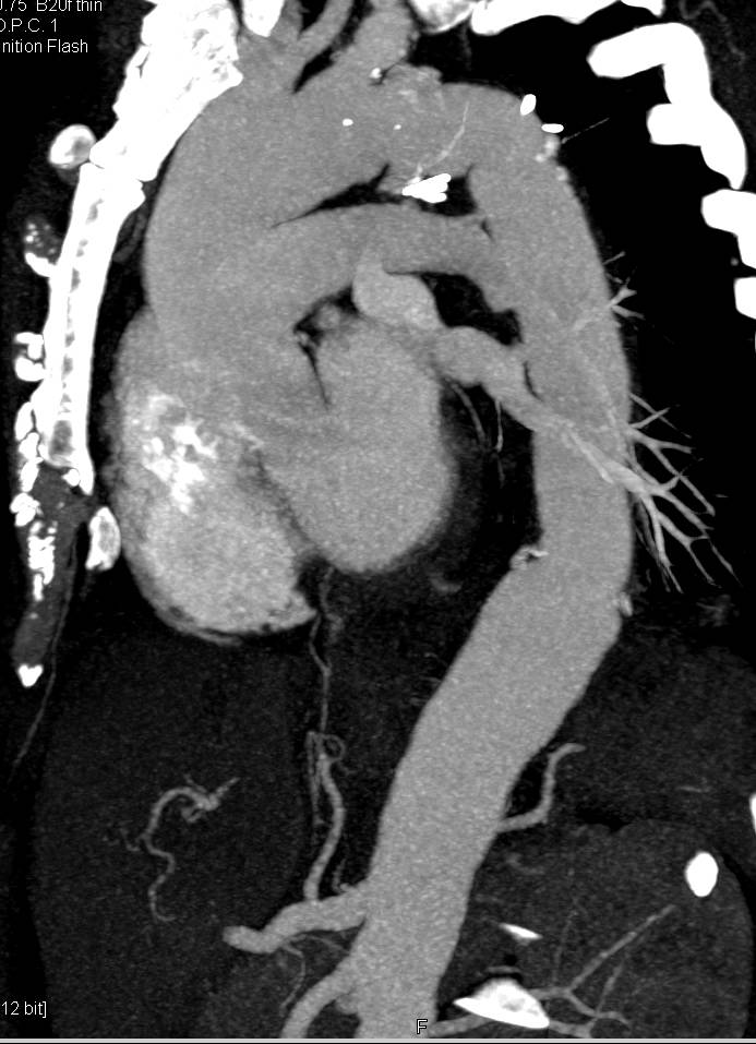 Repair of Descending Thoracic Aneurysm - CTisus CT Scan