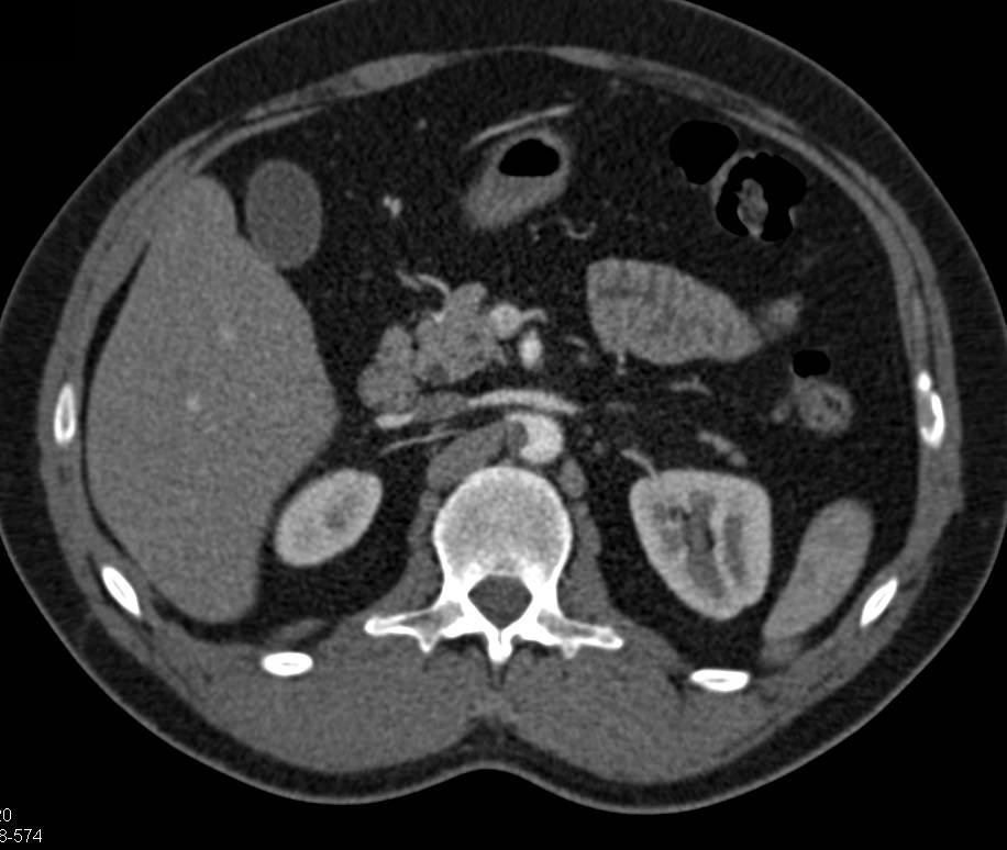 Clots in Aorta and Left Common Iliac Artery and Renal Infarction - CTisus CT Scan