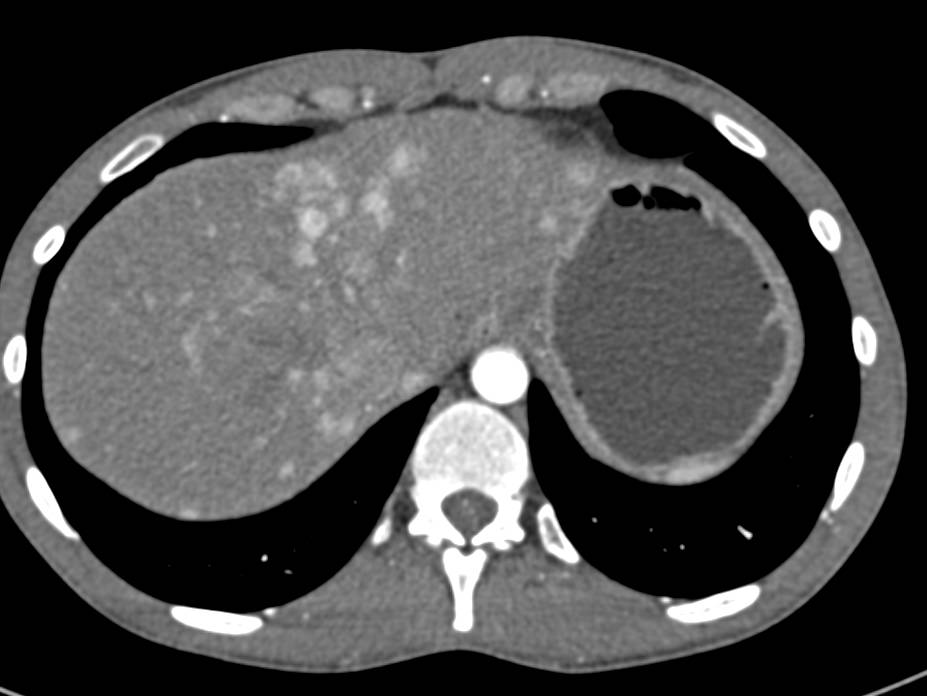 Vascular Liver Metastases Nicely Seen on Arterial Phase Images ...