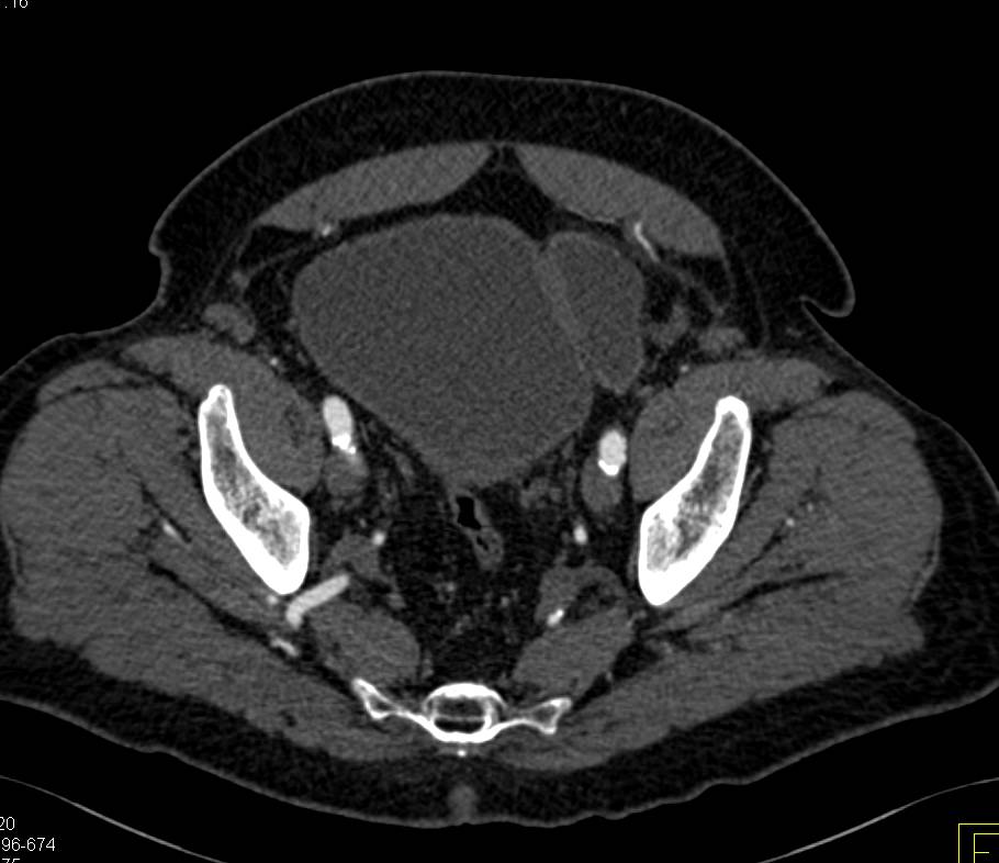 Aortic Aneurysm and incidental Bladder Diverticulum - CTisus CT Scan