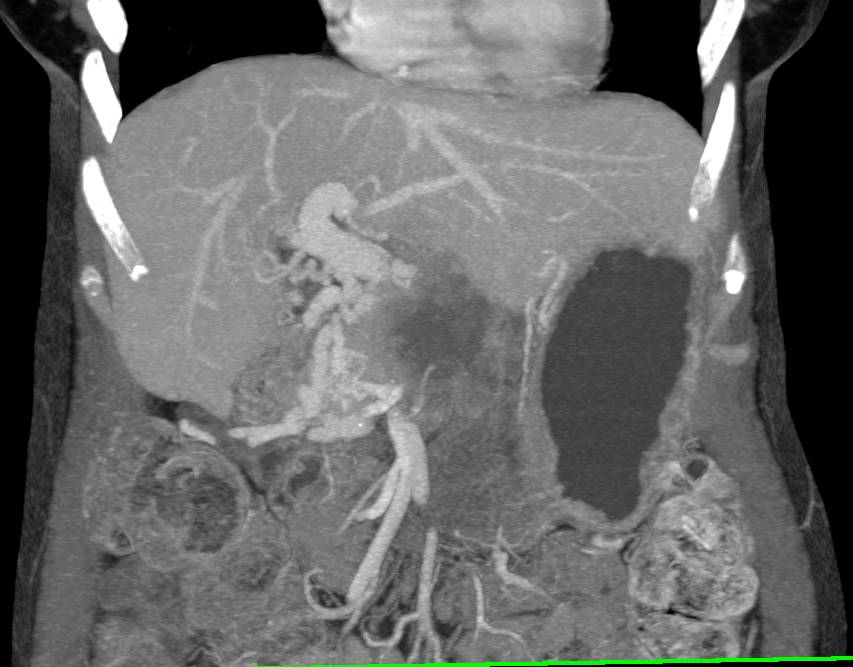 Pancreatic Adenocarcinoma Invades the Portal Vein and Superior Mesenteric Vein (SMV) with Extensive Collaterals - CTisus CT Scan