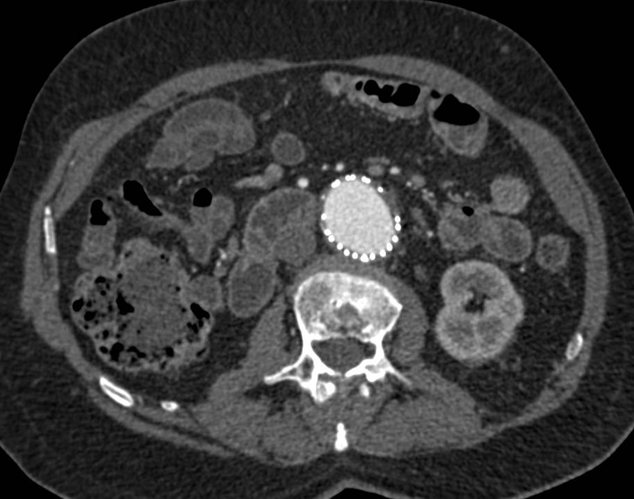 Endovascular Repair of Abdominal Aortic Aneurysm (AAA) with Stents in Renal Artery - CTisus CT Scan