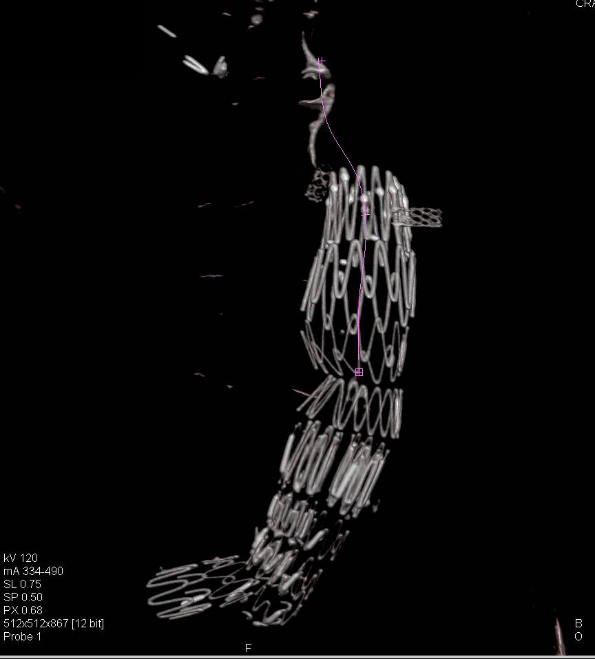 3D Mapping of Aneurysm Stenting with Key Vascular Anatomy Shown - CTisus CT Scan