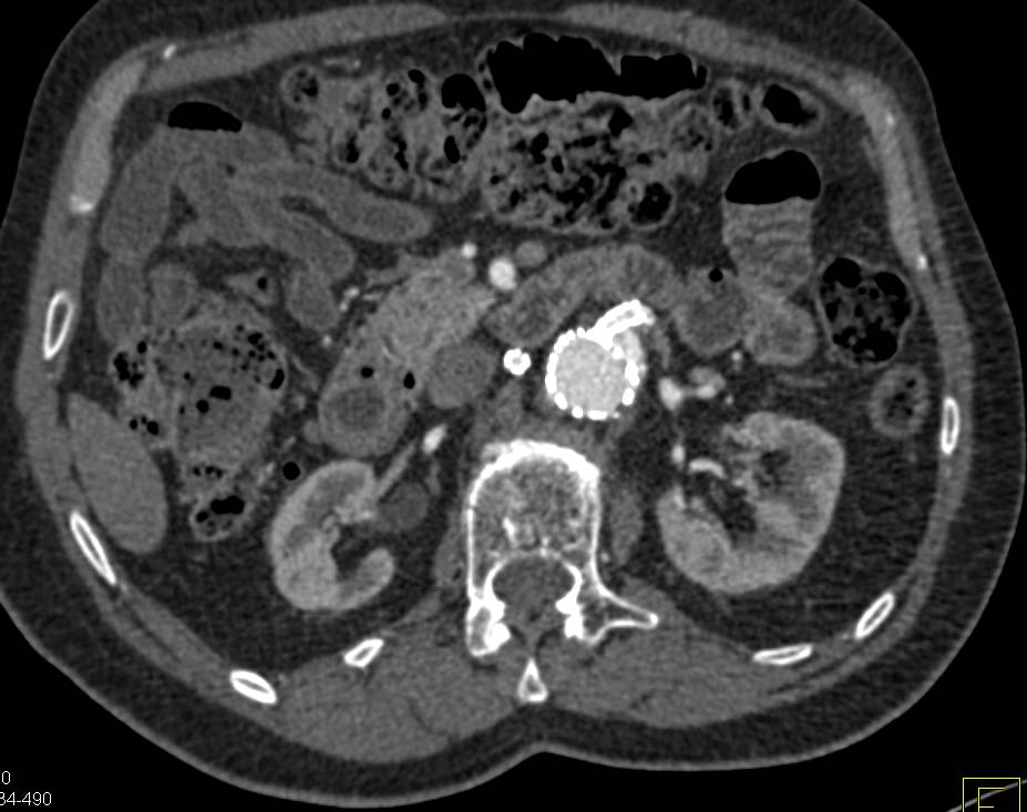 Endovascular Repair of Abdominal Aortic Aneurysm (AAA) with Stents in Superior Mesenteric Artery (SMA) and Right Renal Artery - CTisus CT Scan