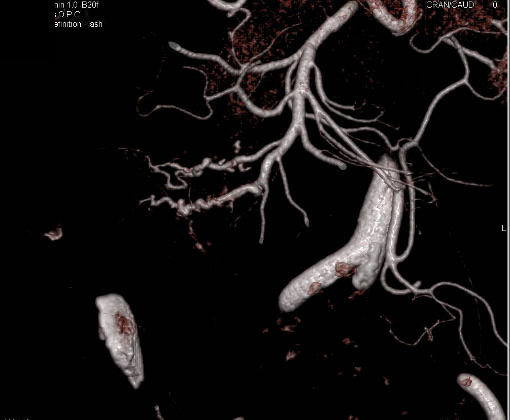 Branches off Superior Mesenteric Artery (SMA) Encased by Carcinoid Tumor Seen with CTA - CTisus CT Scan