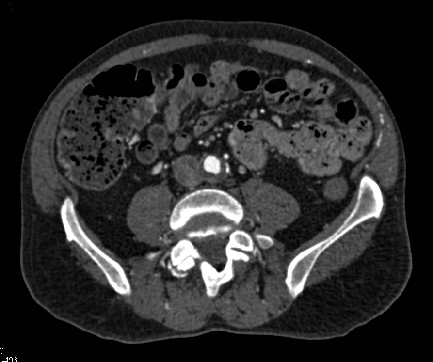 CTA Runoff with Occluded Left Common Iliac Artery and Peripheral Vascular Disease (PVD) - CTisus CT Scan