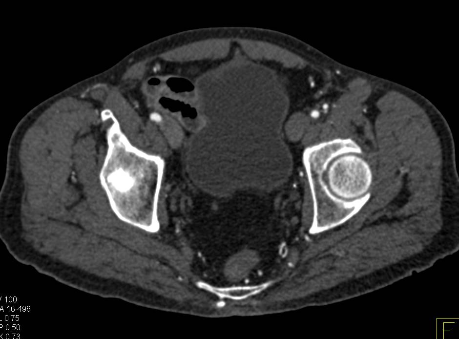 CTA Runoff with Dual Energy CT and Superficial Femoral Artery (SFA) Stenosis - CTisus CT Scan