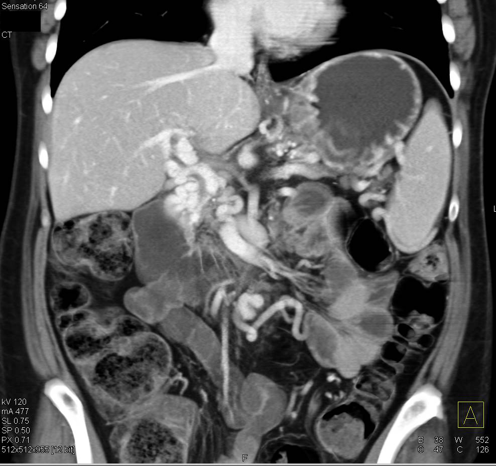 Cavernous Transformation of the Portal Vein in a Patient with Pancreatic Cancer - CTisus CT Scan