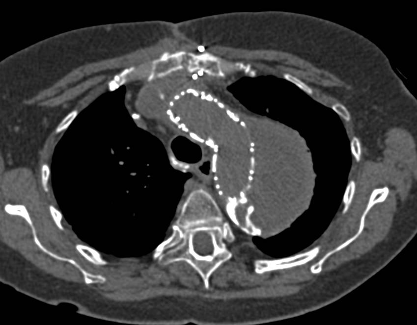 Endovascular Stent Repair of Thoracic Aneurysm with Reimplantation of Great Vessels off the Arch - CTisus CT Scan