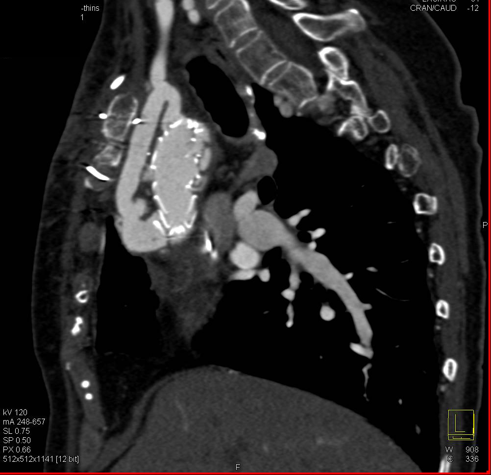 Arch Repair with Stent and Reanastomosis of Arch Vessels - CTisus CT Scan