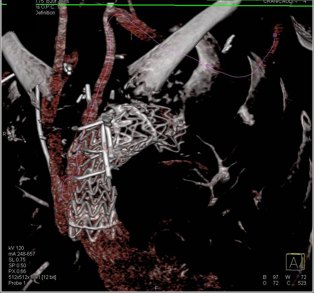 Endovascular Stent with Vessel Repair and Incidental Cystic Pancreatic Lesion - CTisus CT Scan