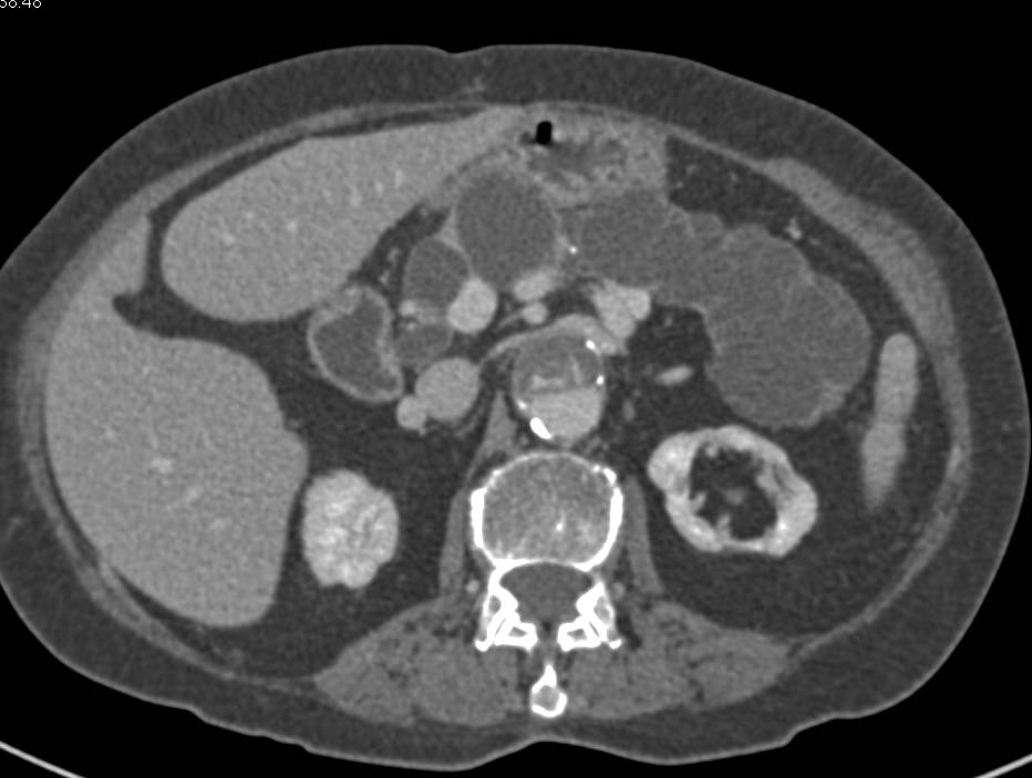 Type A Dissection with Endovascular Stent Repair - CTisus CT Scan