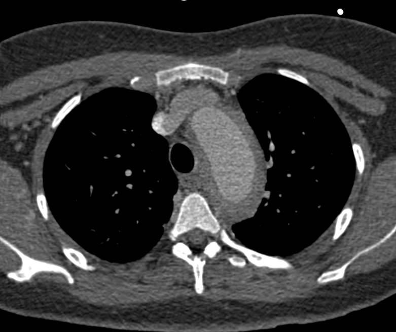 Intramural Hematoma in the Descending Aorta - CTisus CT Scan