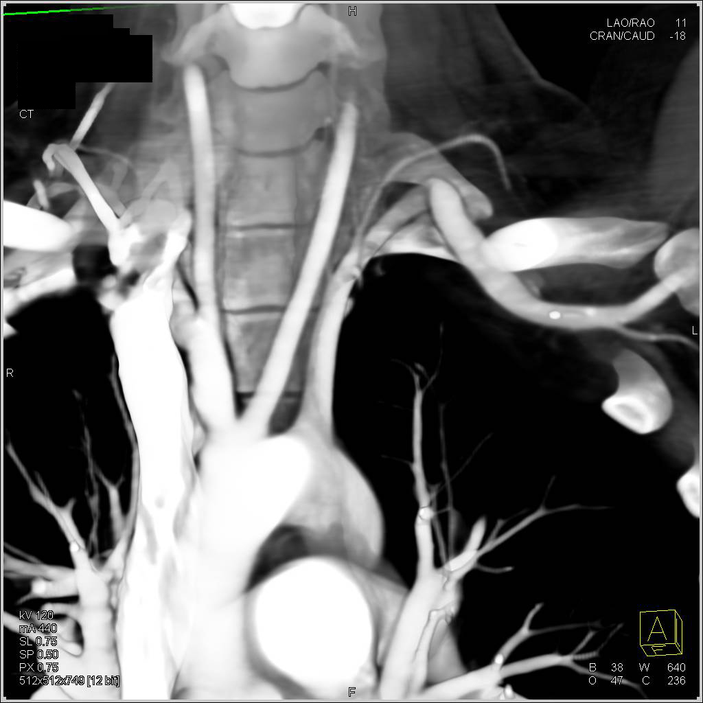 Left Subclavian Artery Narrowing in Patient with Persistent Symptoms of Thoracic Outlet Syndrome - CTisus CT Scan