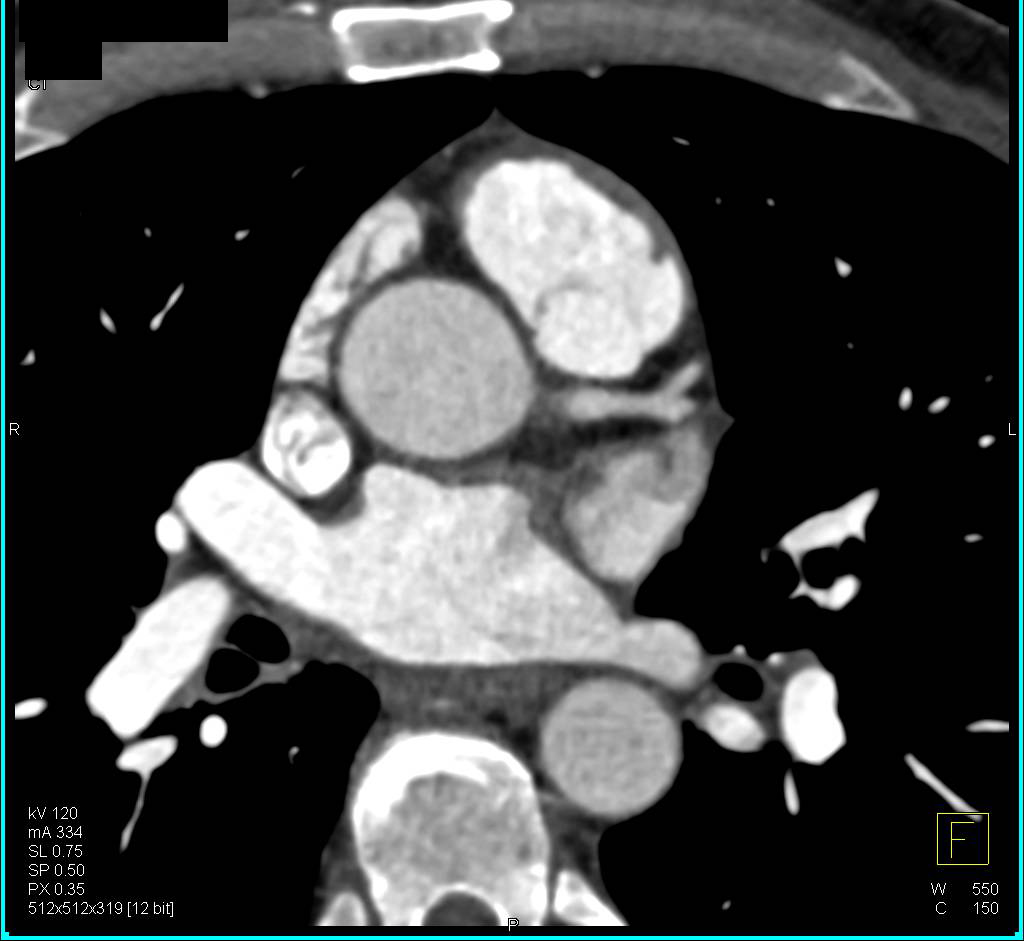 Dilated Sinus of Valsalva in Marfan Disease - CTisus CT Scan