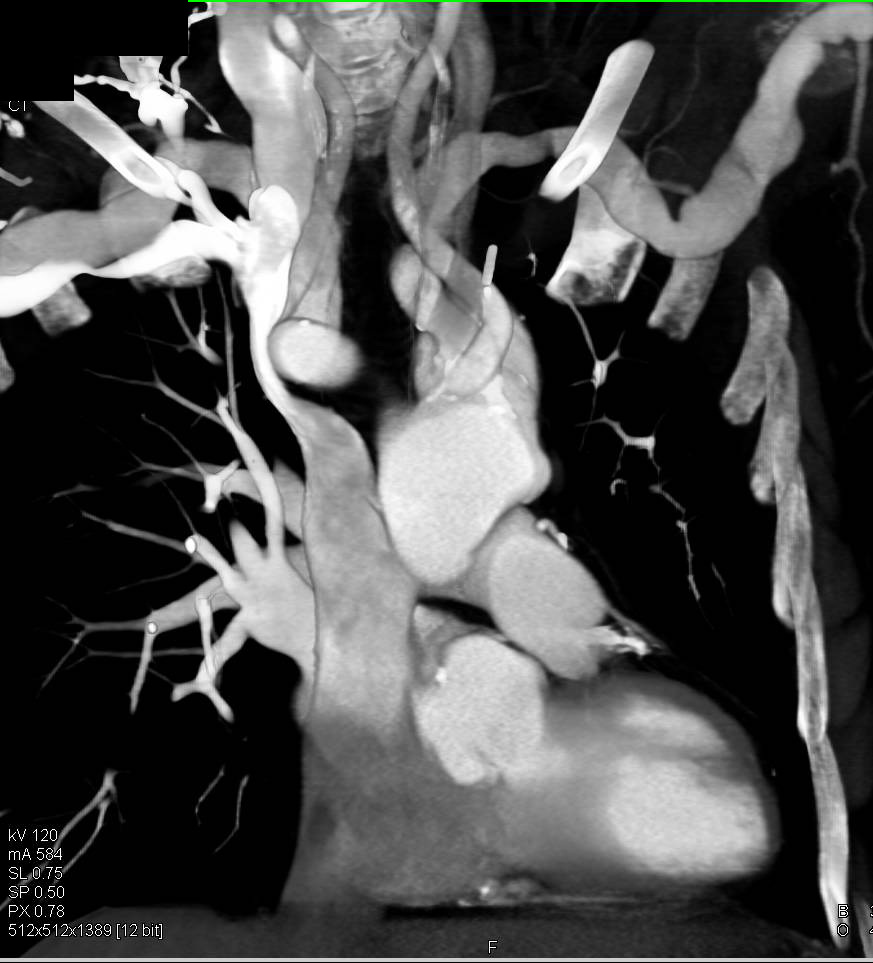 Aortic Root Repair - CTisus CT Scan