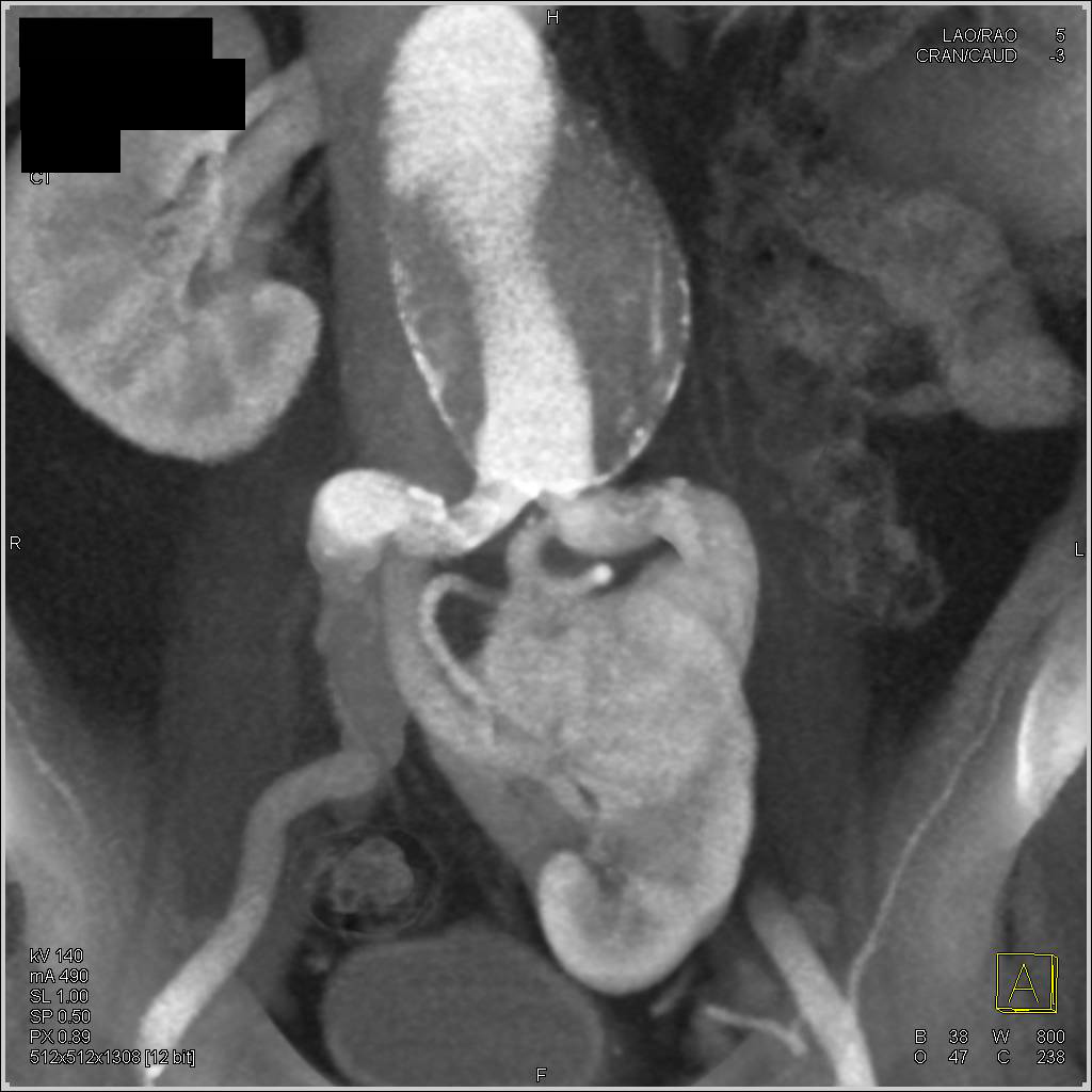 Abdominal Aortic Aneurysm and Pelvic Kidney - CTisus CT Scan