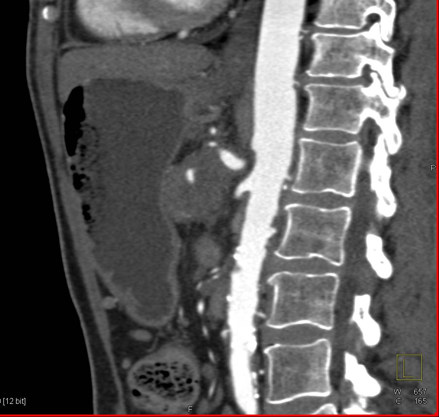 Superior Mesenteric Artery (SMA) Syndrome - CTisus CT Scan