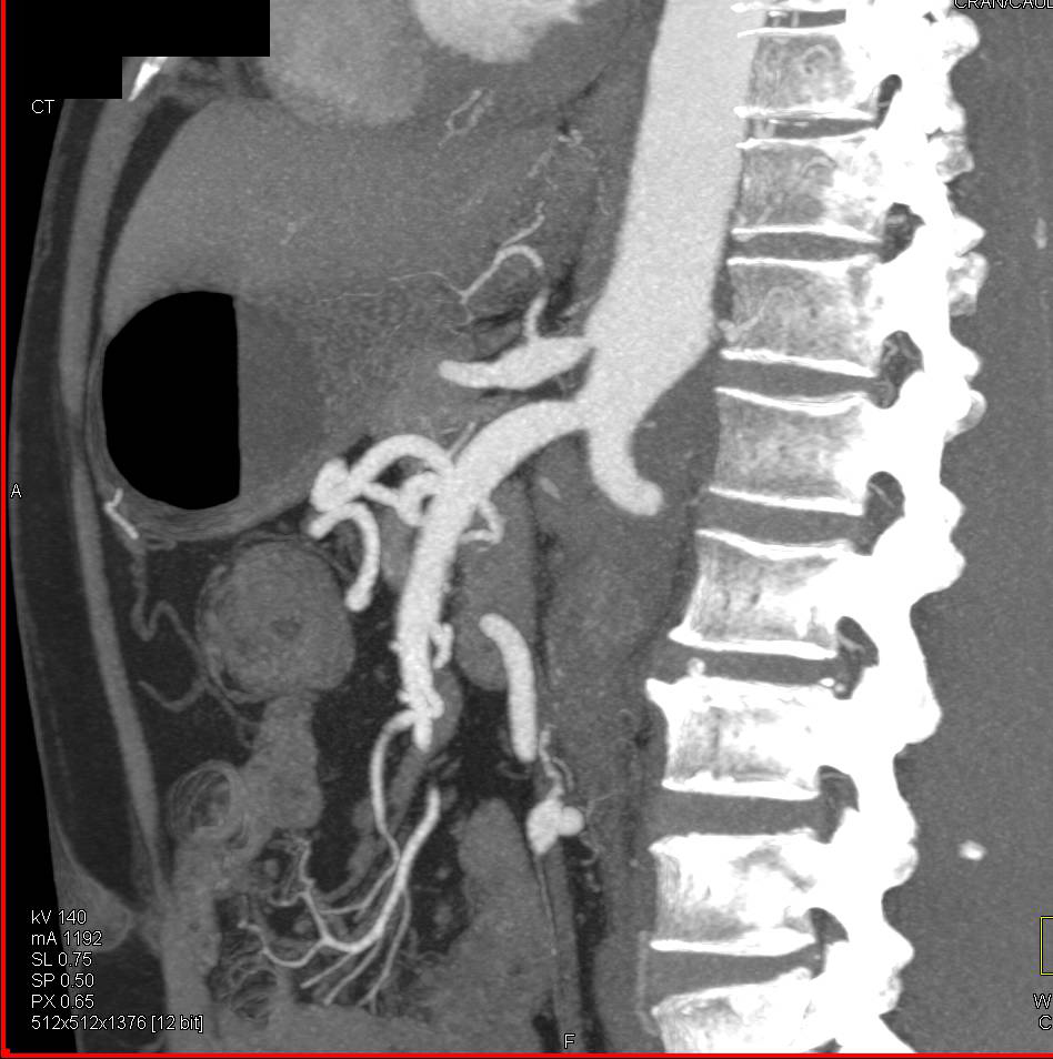 Aortic Occlusion with Collaterals due to Leriche Syndrome - CTisus CT Scan