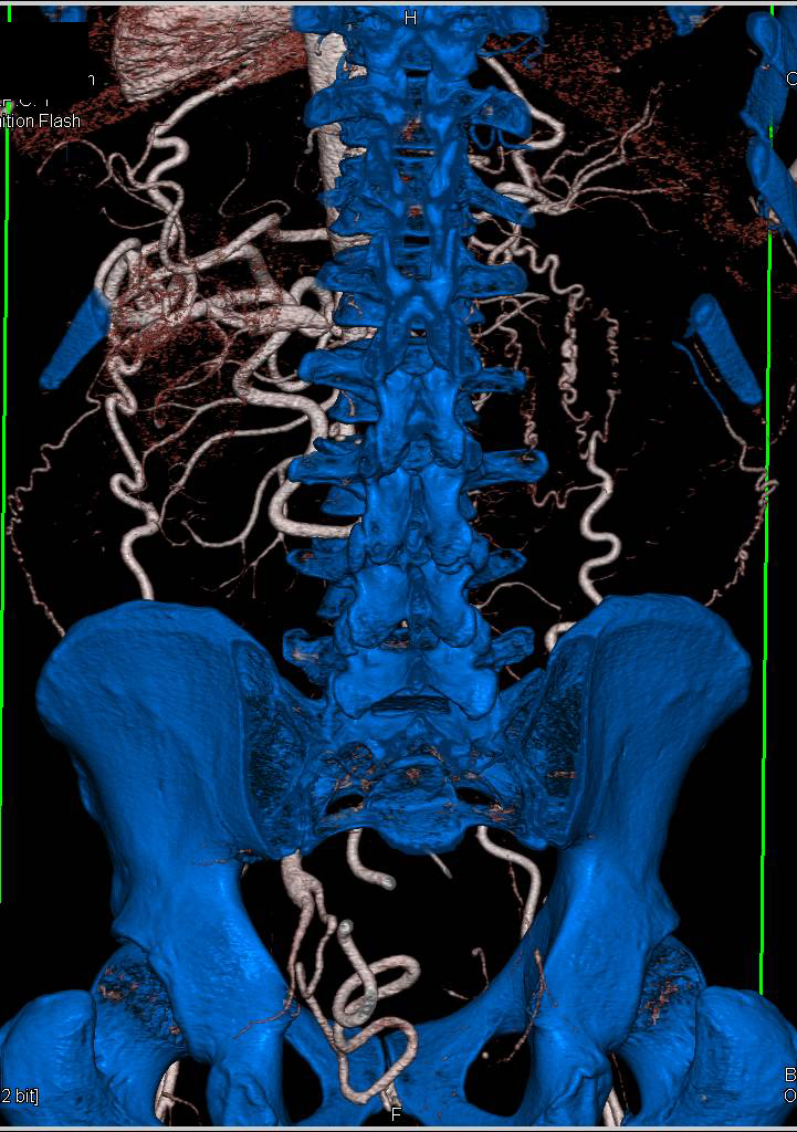 Occluded Abdominal Aorta with Collaterals - CTisus CT Scan