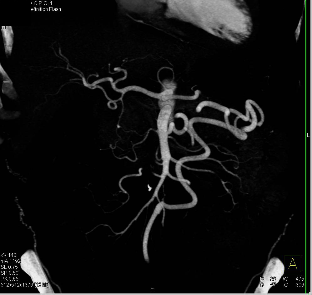 Aortic Occlusion with Collaterals due to Leriche Syndrome - CTisus CT Scan