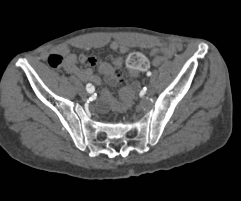 CTA Runoff with Superficial Femoral Artery (SFA) to Popliteal Artery Bypass on Right due to Occlusion Repair - CTisus CT Scan