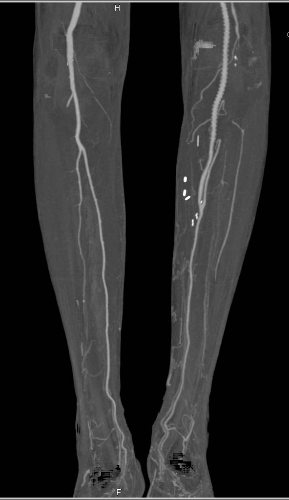 Superficial Femoral Artery (SFA) to Anterior Tibial Artery Bypass Graft - CTisus CT Scan