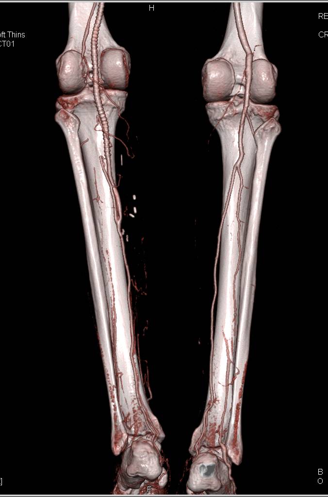 CTA Runoff with Vascular Grafts - CTisus CT Scan