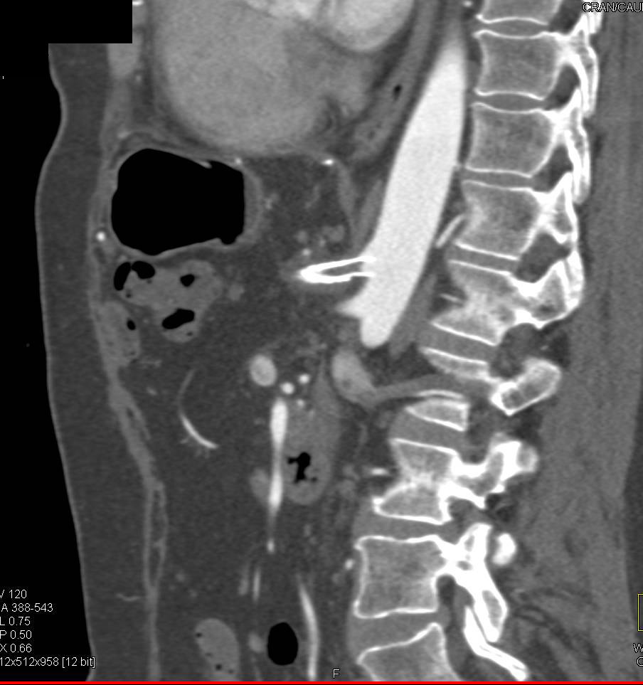 Stent in Celiac Artery is Occluded - CTisus CT Scan