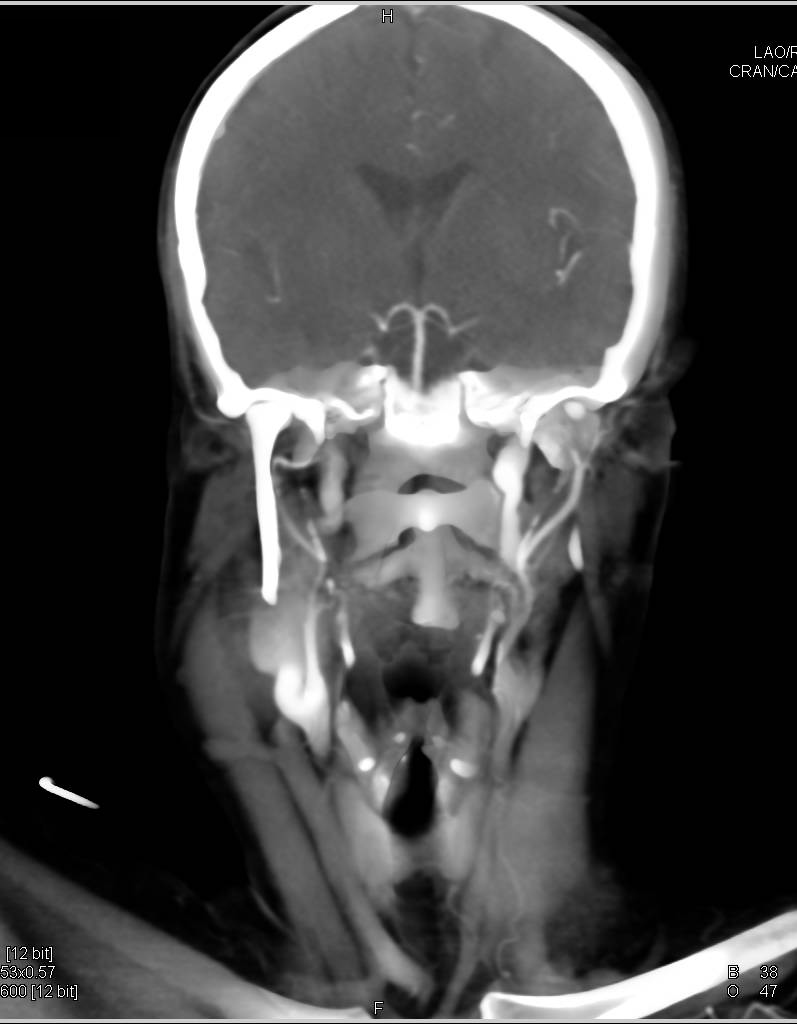 Ehlers-Danlos Syndrome with Multiple Aneurysms Including Carotid Artery - CTisus CT Scan