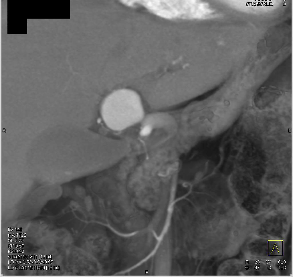 Multiple Aneurysms Including Right Carotid Artery and Hepatic Artery in Patient with Ehlers-Danlos Syndrome - CTisus CT Scan