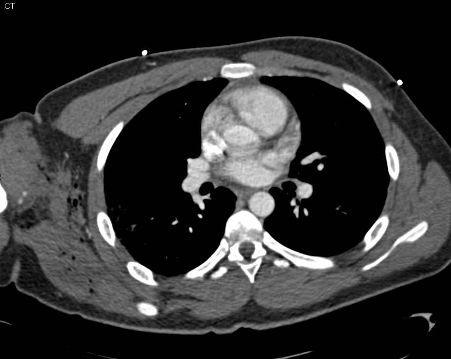 GSW Shoulder with CTA with Spasm in Brachial Artery - CTisus CT Scan