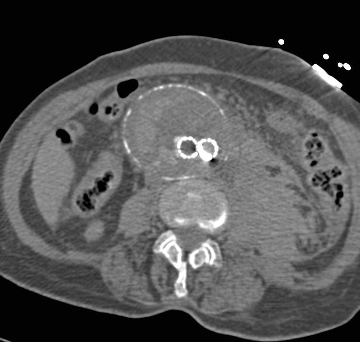 Aortic Aneurysm with Endovascular Stent with retroperitoneal Bleed, Endoleak and Occlusion of One Limb of the Graft - CTisus CT Scan