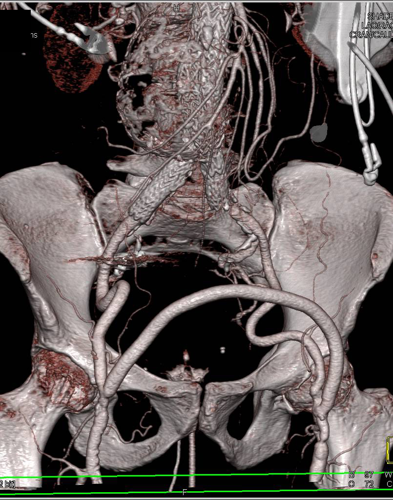 Endovascular Stent Repair and Fem-Fem Bypass Graft - CTisus CT Scan