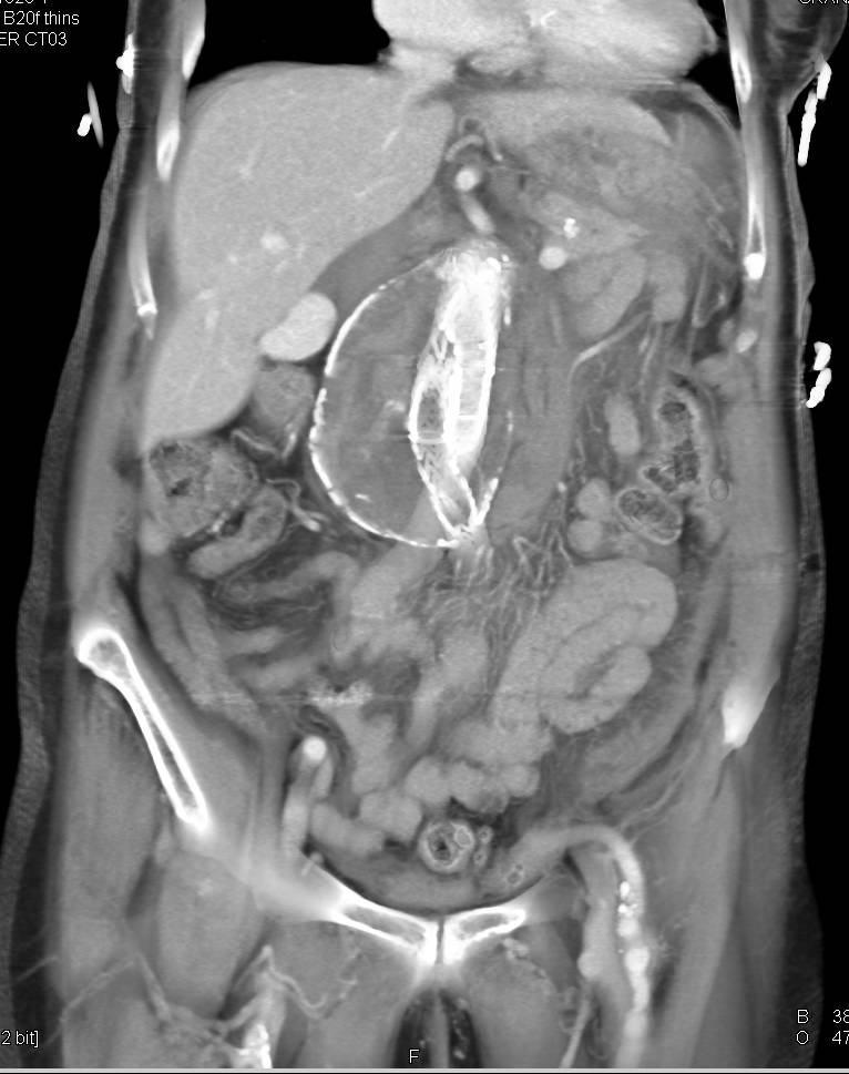 Aortic Aneurysm with Endovascular Stent and Numerous Complication Including Retroperitoneal Bleed - CTisus CT Scan