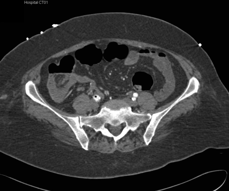 Catheter in Right Iliac Artery - CTisus CT Scan