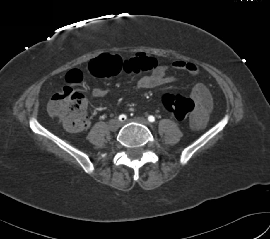 Aortic Balloon Pump in Typical Configuration - CTisus CT Scan