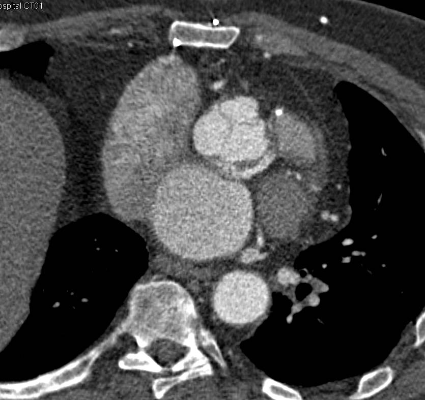 Dilated Ascending Aorta - CTisus CT Scan